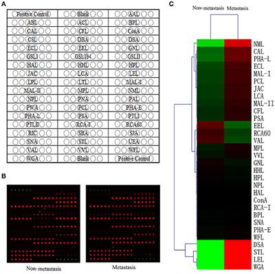 Assessment of Hepatocellular Carcinoma Metastasis Glycobiomarkers Using Advanced Quantitative N-glycoproteome Analysis